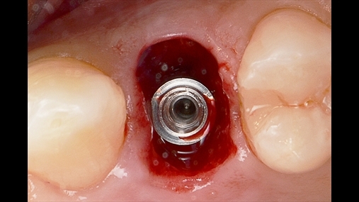 4. Vendosja 1 mm nën kreshtë e implantit Shelta SL diametri 4.25 dhe lartësia 10.00 mm sipas protokollit XA
