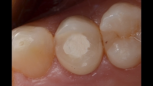 15. Proteza prfundimtare e fiksuar n gojn e pacientit: pamje okluzale dhe vestibulare