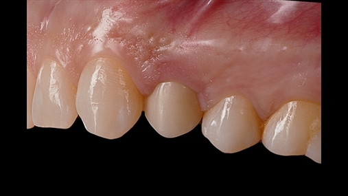 15. Proteza prfundimtare e fiksuar n gojn e pacientit: pamje okluzale dhe vestibulare