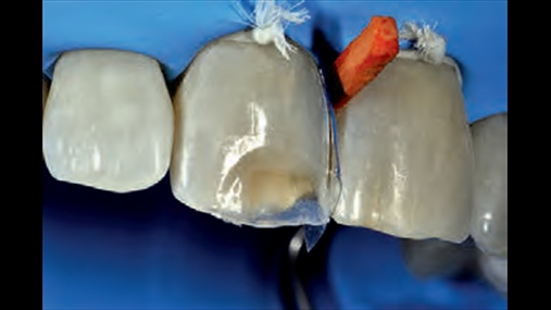 Fig. 10 Pareti interproksimal mezial i 1.1 rikonstruktohet me nj mbushje mase dentine A4 me trashsi rreth 1mm n drejtim mezio-distal q t ket nj korniz opake interproksimale. M pas vijon polimerizimi pr 60 sekonda. Me t njjtn mas dentine aplikohet nj shtres rreth 0,5 mm n nivel t perimetrit incizal t rikonstruksionit q t kemi kshtu nj korniz opake edhe n nivel incizal.