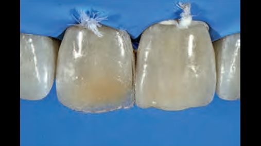 Fig. 13 I njjti smalt i tejdukshm-opaleshent i prdorur pr rikonstruksionin e paretit palatal aplikohet midis kornizs incizale opake dhe relieveve paraprakisht t gdhendur dhe midis siprfaqes interproksimale meziale opake dhe trupit dentinal qendror, n hapsirat e lna nga modelimi paraprak. Vijon polimerizimi pr 60 sekonda. N baz t karakteristikave kromatike opaleshente si qelibar do t spikas shum midis relieveve dhe porcioneve m opake. Nj super ngjyr e bardh opake aplikohet n sasi minimale n korrespondenc t margjins incizale n dy pika pr t rikrijuar zonn me opacitet m t madh t evidentuar n hartn kromatike t 2.1 n faz studimi. Vijon polimerizimi pr 20 sekonda