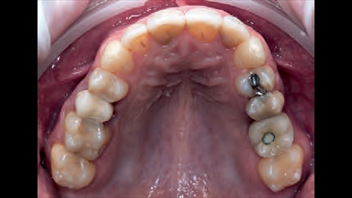 Fig. 2 Pamje okluzale superiore: prania e restaurimeve të shumta të ngarkuar dhe mungesa e mbushjes në implantin 2.6