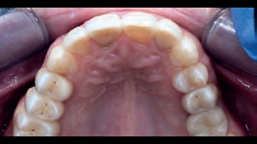 Fig. 12c pamje finale e rehabilitimit që dëshmon stabilitet të indeve të buta të ripozicionuar dhe integrim të manifakturës me elemente të tjera dentare