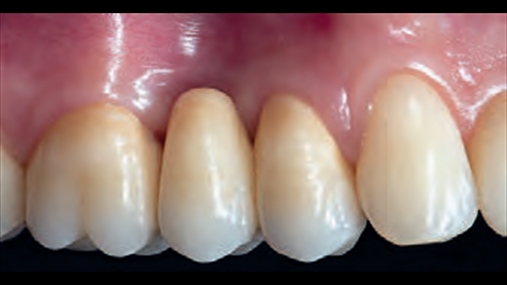 Fig. 12a pamje finale e rehabilitimit që dëshmon stabilitet të indeve të buta të ripozicionuar dhe integrim të manifakturës me elemente të tjera dentare