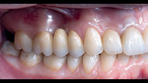 Fig. 12b pamje finale e rehabilitimit që dëshmon stabilitet të indeve të buta të ripozicionuar dhe integrim të manifakturës me elemente të tjera dentare